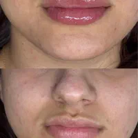 جشنواره ویژه تزریق ژل و مزو و پی آرپی درمطب|خدمات آرایشگری و زیبایی|اصفهان, نقش جهان|دیوار