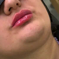 فیلر و بوتاکس