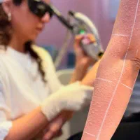 لیزر مو های زایددستگاه کندلا (شاتی ) بهترین۲۰۲۵|خدمات آرایشگری و زیبایی|کرج, احدآباد|دیوار