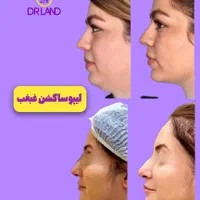 عمل لیپو شکم پهلو غبغب ابدو ماموپلاستی پروتز اقساط