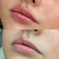 تخفیف 40 درصد کلینیک فیلربوتاکس ژل صورت و بدن