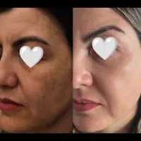 بیوممتیک ضد لک و روشن کننده پوست