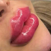 ژل بوتاکس|خدمات آرایشگری و زیبایی|اهواز, پادادشهر|دیوار
