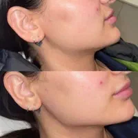 بوتاکس ، فیلر کل صورت ، مزو تراپی ، خال برداری|خدمات آرایشگری و زیبایی|اردبیل, |دیوار