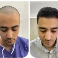 کاشت مو فقط 18میلیون تومان|خدمات آرایشگری و زیبایی|رشت, گلسار|دیوار