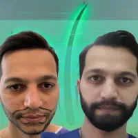 کاشت مو و ریش با ضمانت|خدمات آرایشگری و زیبایی|شیراز, قصرالدشت|دیوار
