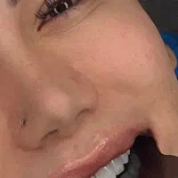 جشنواره زمستانی کامپوزیت دندان