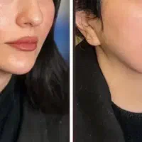 ژل ،فیلر و بوتاکس|خدمات آرایشگری و زیبایی|صفادشت, |دیوار