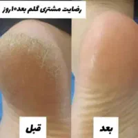 کرم ترک پا گیاهی با جواب دهی 3روزه|آرایشی، بهداشتی، درمانی|سوسنگرد, |دیوار