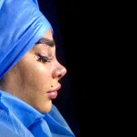 تیپ پلاستی ۱۶ بدون بیهوشی|خدمات آرایشگری و زیبایی|تهران, آسمان|دیوار