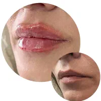 تزریق فیلر وبوتاکس وجوانساز صورت|خدمات آرایشگری و زیبایی|کارون, |دیوار