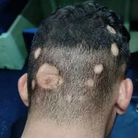 درمان ریشه ای آلوپسی
