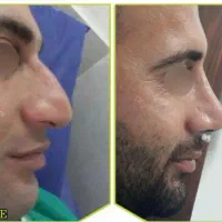 راهنمایی عمل بینی