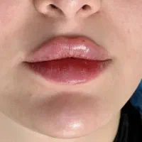 اموزش ‌‌و خدمات ژل و بوتاکس و مزو