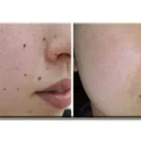 برداشتن انواع خال وکک ومک وزائده گوشتی