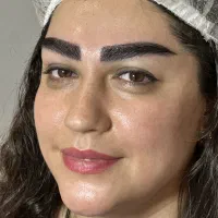 جشنواره تخفیفی میکروکاشت ابرو vip،کاشت مو،غبغب