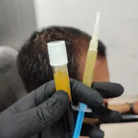 پی آر پی و پی آر اف بوتاکس و مزوتراپی وهیرفیلر