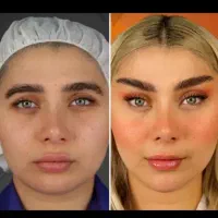 عمل جراحی بینی 40%تخفیف (رینوپلاستی)در کرج