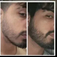 ریش و موی پرتراکم کمتر از سی روز