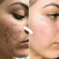 میکرو نیدلینگ ومزونیدلینگ لک جوانسازی جوش