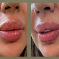 ژل بوتاکس،لابیاپلاستی،حذف لک،ریموو تتو،لاغری|خدمات آرایشگری و زیبایی|ارومیه, |دیوار