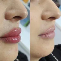 فیلر،بوتاکس،لیزر،مزو،فیشال