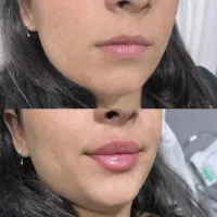 مدل فیلر بوتاکس|خدمات آرایشگری و زیبایی|سنندج, |دیوار