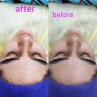 پاکسازی صورت و کاشت موقت(هیدن) و لیفت ابرو