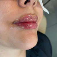 لیزر.ژل.بوتاکس.مزوتراپی.هایفوتراپی