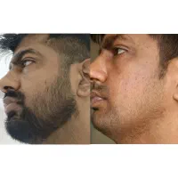 راهکار رویش ریش