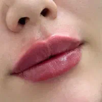 تزریق فیلر و بوتاکس