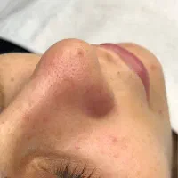 رفع چین و چروک،میکرونیدلینگ،جوانسازی صورت،فیشالVIP|خدمات آرایشگری و زیبایی|قدس, شهر‌قدس|دیوار