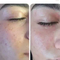 رفع کک،مک صورت درسه جلسه، لاغری درکلینیک سهندفازیک