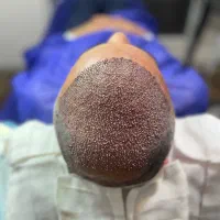 کاشت مو تضمینی با پکیج داروی رایگان