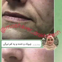 جوانسازی بیومیتیک بدون کار های تهاجمی