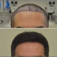 کاشت مو و ابرو ریمو تتو با دستگاه پیشرفته اهواز