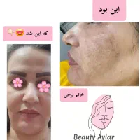 پوستت کدر و تیره شده نگران نباش با آیلار میدرخشی|آرایشی، بهداشتی، درمانی|میبد, |دیوار