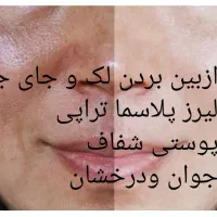 لیزرمیکرو پلاسما/لیفت زیبایی/ بینی /بلفاروپلاستی