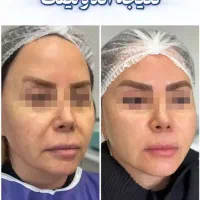 (ااندولیفت)کانتورینگ و لیفت بدون جراحی طی یک مرحله