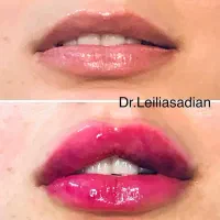 تزریق فیلر (ژل ) لیفت با نخ بوتاکس مزوتراپی|خدمات آرایشگری و زیبایی|مشهد, کوثر|دیوار