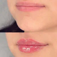 مدل ژل و بوتاکس|خدمات آرایشگری و زیبایی|شیراز, ملاصدرا|دیوار