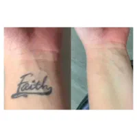 جشنواره حذف تتو و خالکوبی تضمینی درمطب پزشک