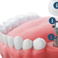 ایمپلنت کره ای ۶۵۰۰ با شرایط اقساط