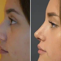جراحی بینی با شرایط ویژه