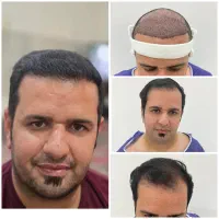 کاشت مو یا معجزه.خط رویش طبیعی تراکم بالا تضمینی|خدمات آرایشگری و زیبایی|یزد, |دیوار