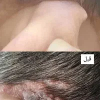 درمان گیاهی زگیل و تبخال مشاوره رایگان|آرایشی، بهداشتی، درمانی|تهران, سعادت‌آباد|دیوار
