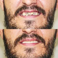 تخفیفات ویژه دندانپزشکی(عصب کشی،پرکردن،کشیدن،جراحی|خدمات آرایشگری و زیبایی|شیراز, قصرالدشت|دیوار