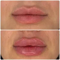 تزریق فیلر ،ژل ، بوتاکس، مزو ، مزوژل کلینیک زیبایی