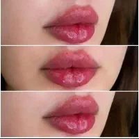 بوتاکس مصپورت ۵۰۰و فیلر اودری سی سی ۵۰۰