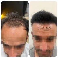 کاشت مو|خدمات آرایشگری و زیبایی|تهران, امانیه|دیوار